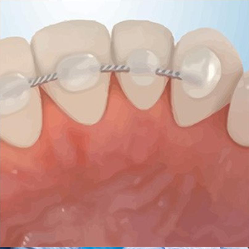 Ceramic Braces Before and After