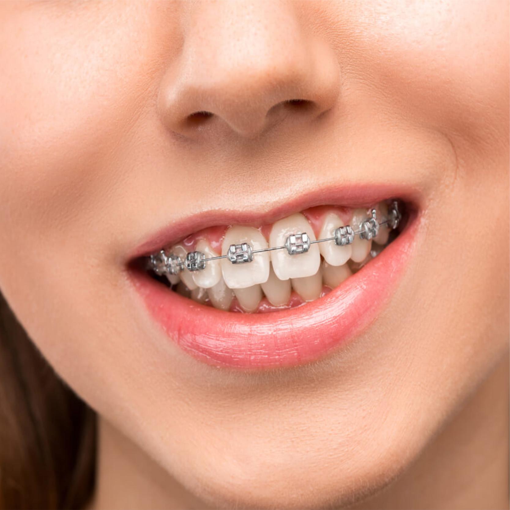 Damon Braces Orthodontist near me