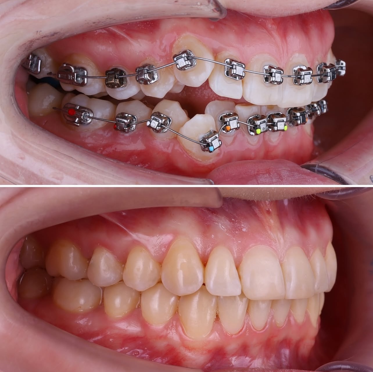 Braces Metal