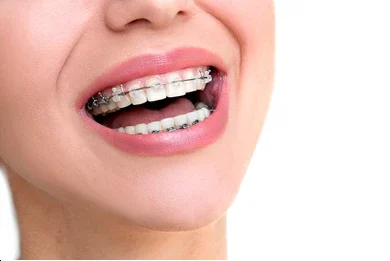 Damon braces clear braces near me