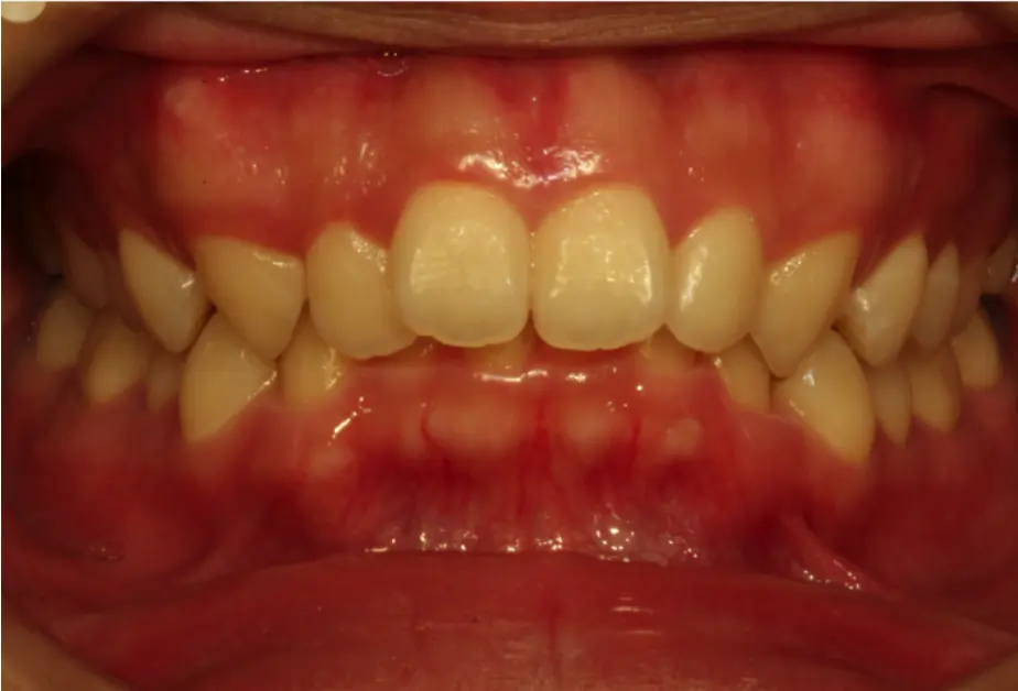 deep bite orthodontics