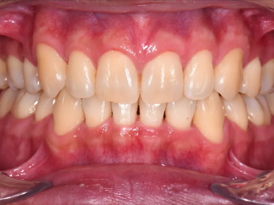 blocked-out tooth