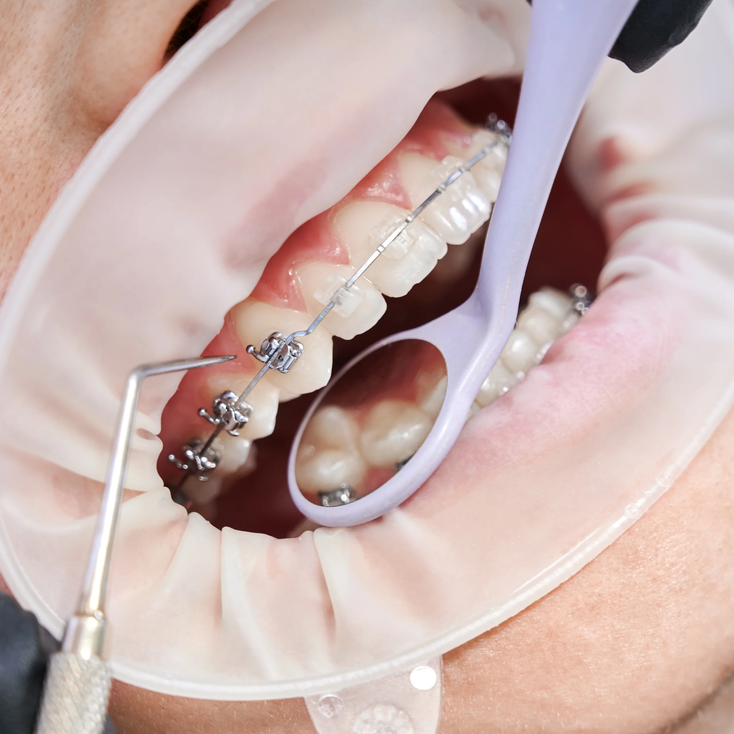 Clear braces near me