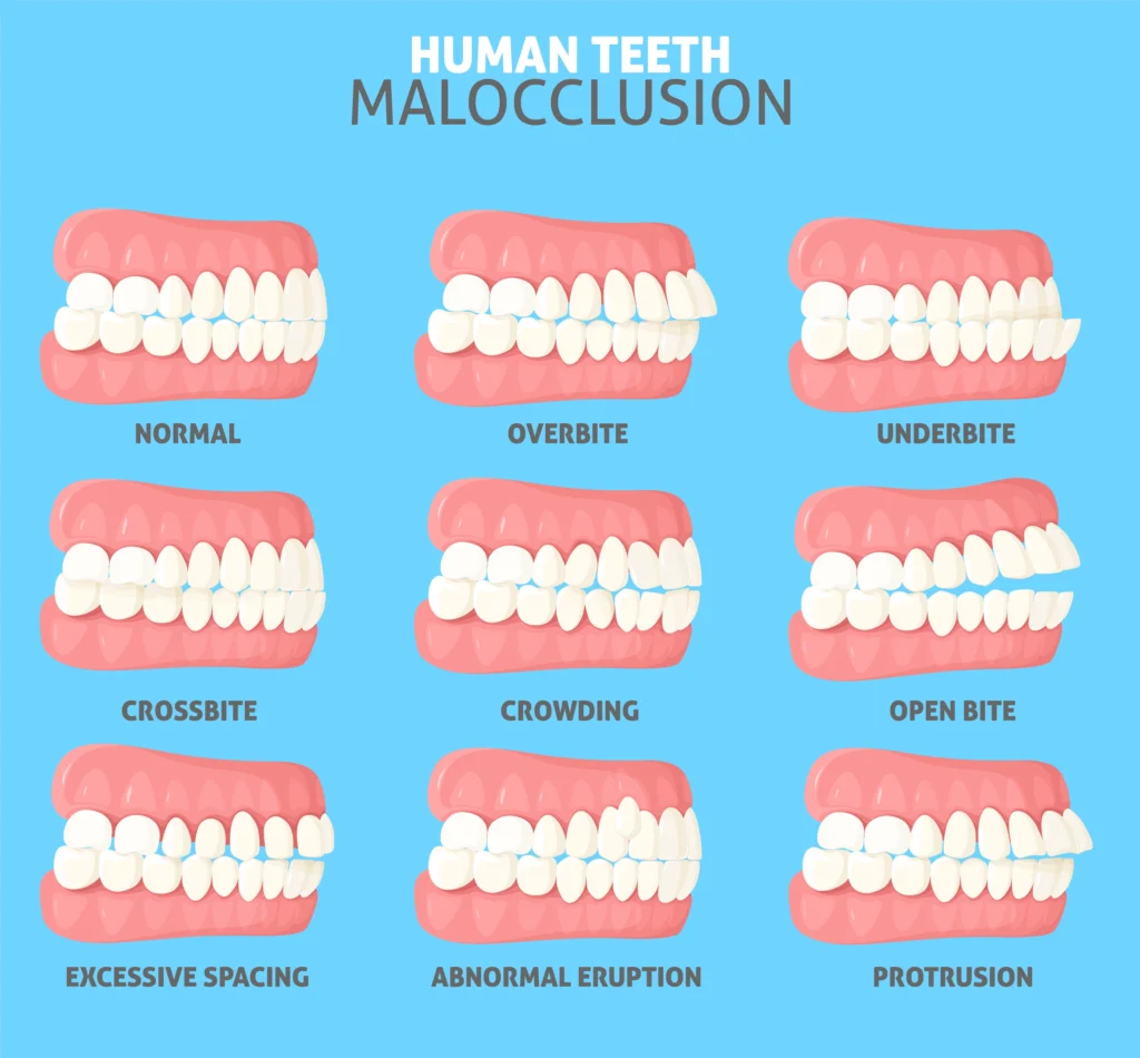 Orthodontic Problems Affect Your Speech
