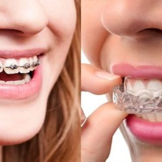 Traditional Braces vs. Clear Aligners:Which Smile Solution Is Right For You? 10 Braces vs Invisalign