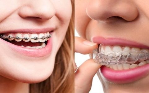 Braces vs Invisalign