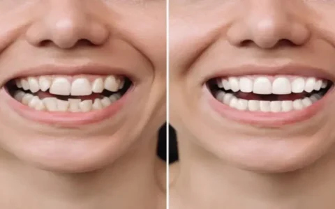 Dental Crowding
