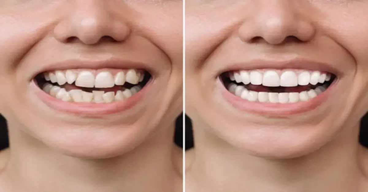 Dental Crowding