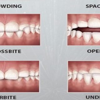 What Are Some Common Orthodontic Problems?Let’s Find Out. 8 Common Orthodontic Problems