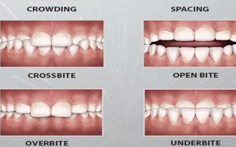 Common Orthodontic Problems