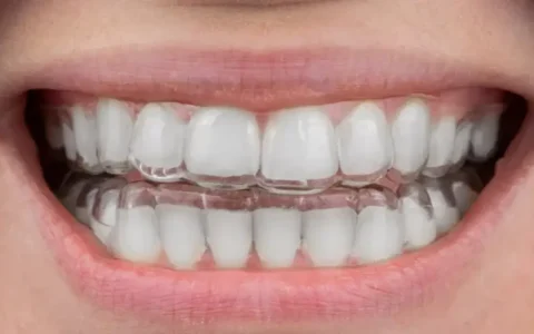 Clear Aligners in Jumeirah Dubai