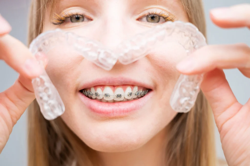 Self-Ligating Braces