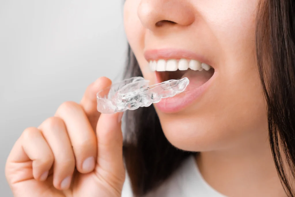 Clear Aligner Treatment 