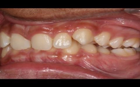 Understanding Overbite