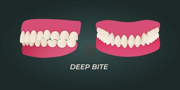 Overbite 