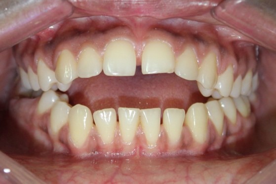 Open Bite 