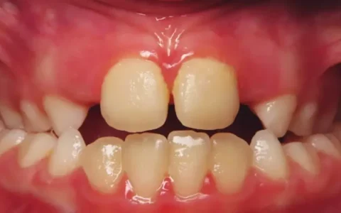 Crossbite