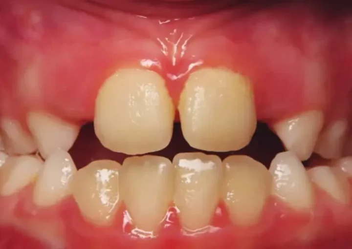 Crossbite