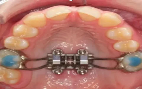 Orthodontic Expander