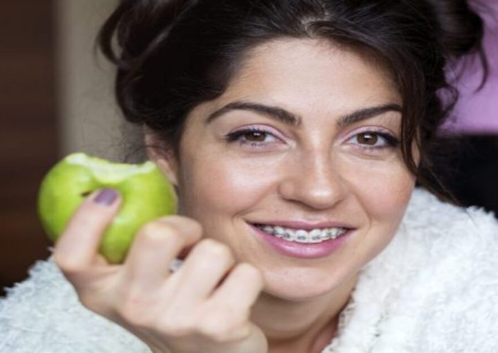 Can Adults Get Braces in Jumeirah, Dubai? A Complete Guide to Braces for Adults. 1 Braces for Adults Cost