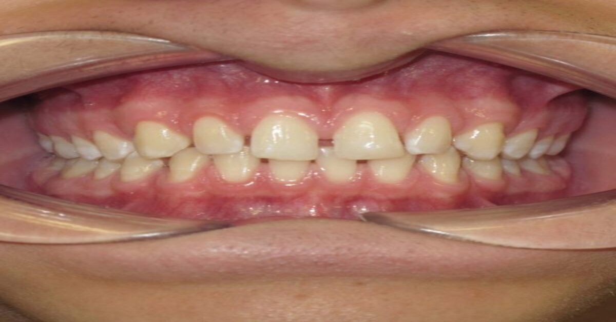 Dental Spacing