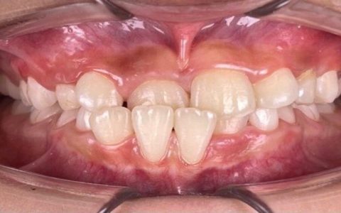 Underbite