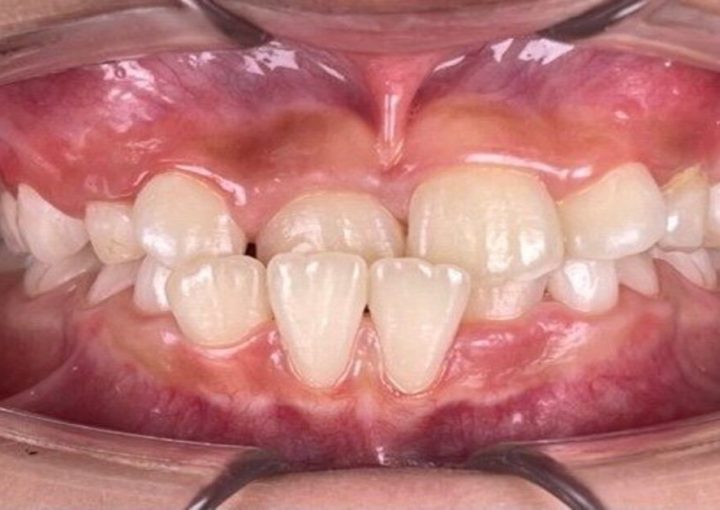 What Is an Underbite—and How Can It Be Corrected? 1 Underbite