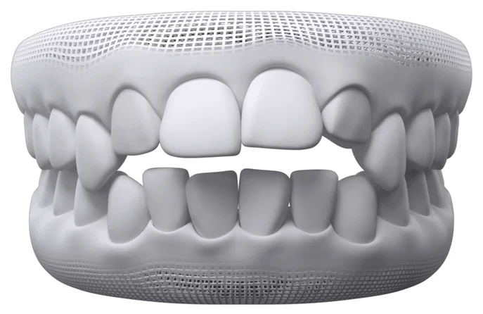 Dental Open Bite