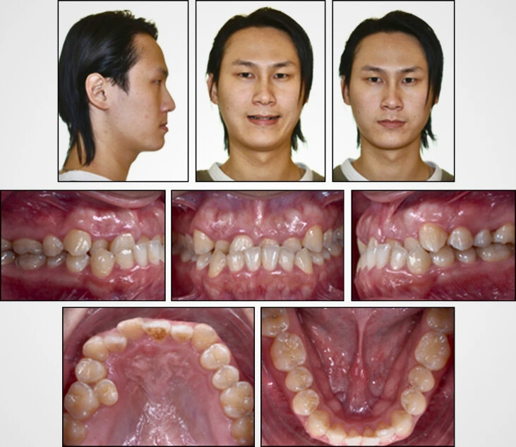 underbite treatment for adults