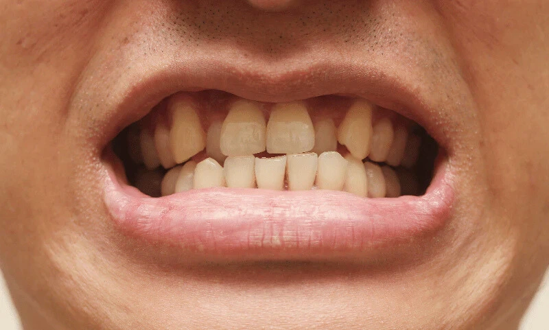 Posterior Cross bite treatment