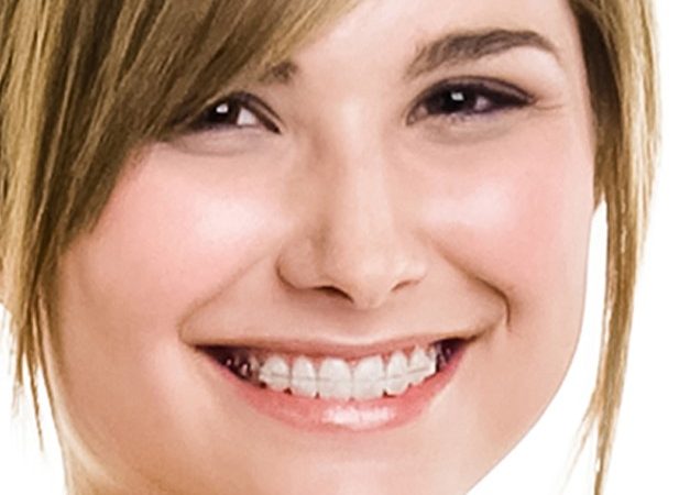 Damon Self-Ligating System: The Sophisticated Braces 3 Damon Self Ligating System