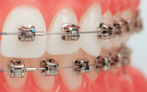 Damon Braces