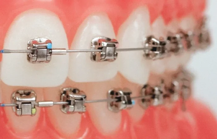 What to Expect with Damon Braces in Dubai: Cost, Appearance, Cleaning & Real-World Results 1 Damon Braces